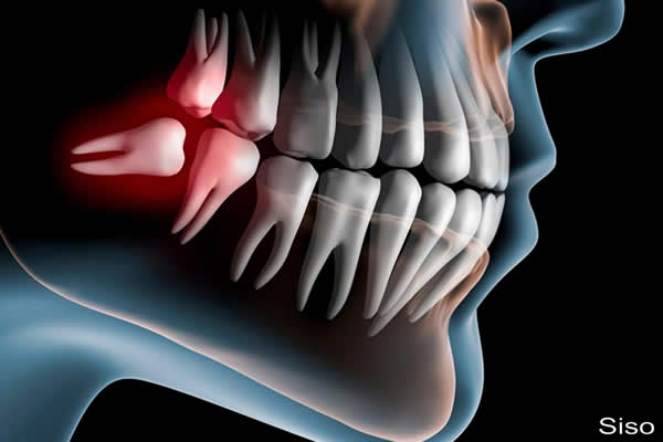 Benefícios de se retirar os dentes de siso