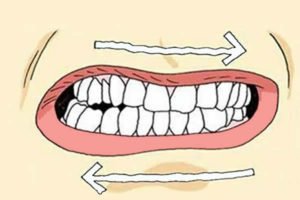 Bruxismo: O que é? E como tratar?